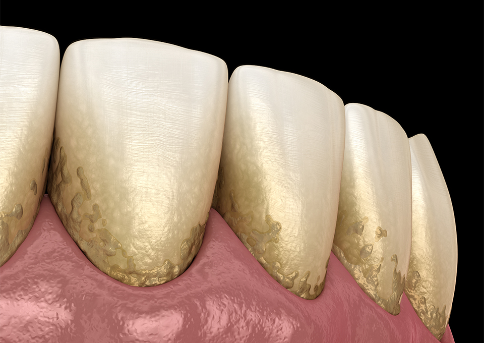 歯周病が進行するとどうなる？