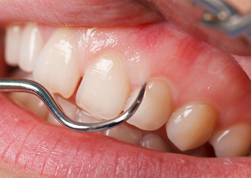 スケーリング・ルートプレーニング