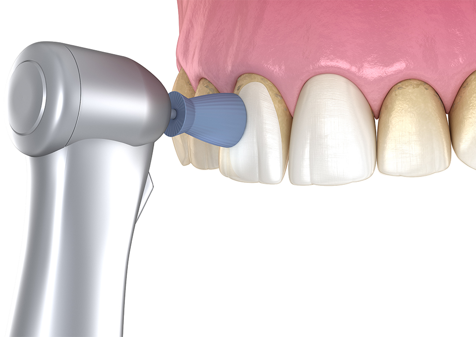 歯周病予防のためのクリーニング