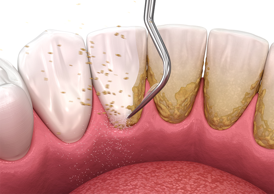 治療後のメンテナンス