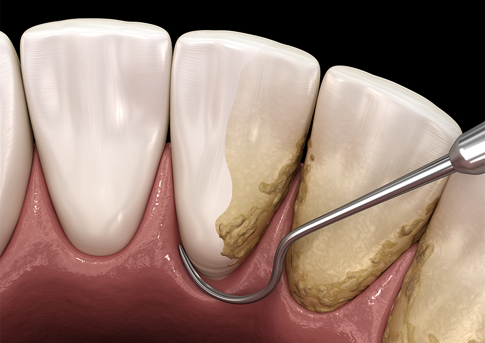 歯周病の原因とリスク要因