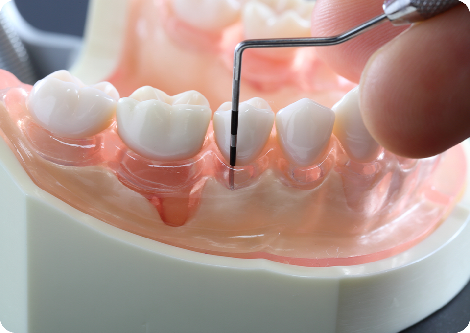 診療案内_02 歯周病